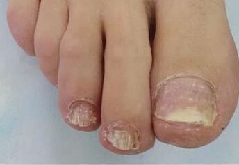 Trouble caused by nail fungus