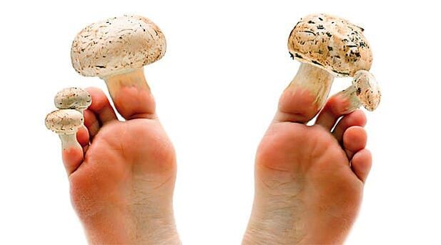 Toenail fungus can be prevented