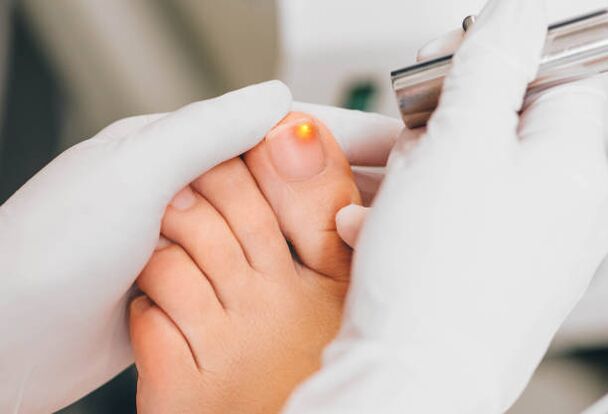 Laser treatment for toenail fungus