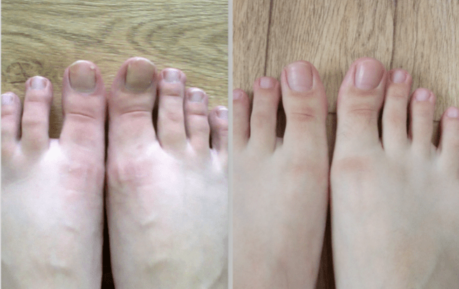 Toenail fungus before and after treatment