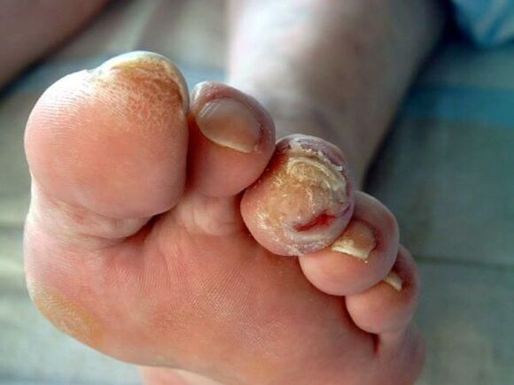 Complications of onychomycosis