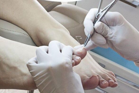 Doctor treats onychomycosis