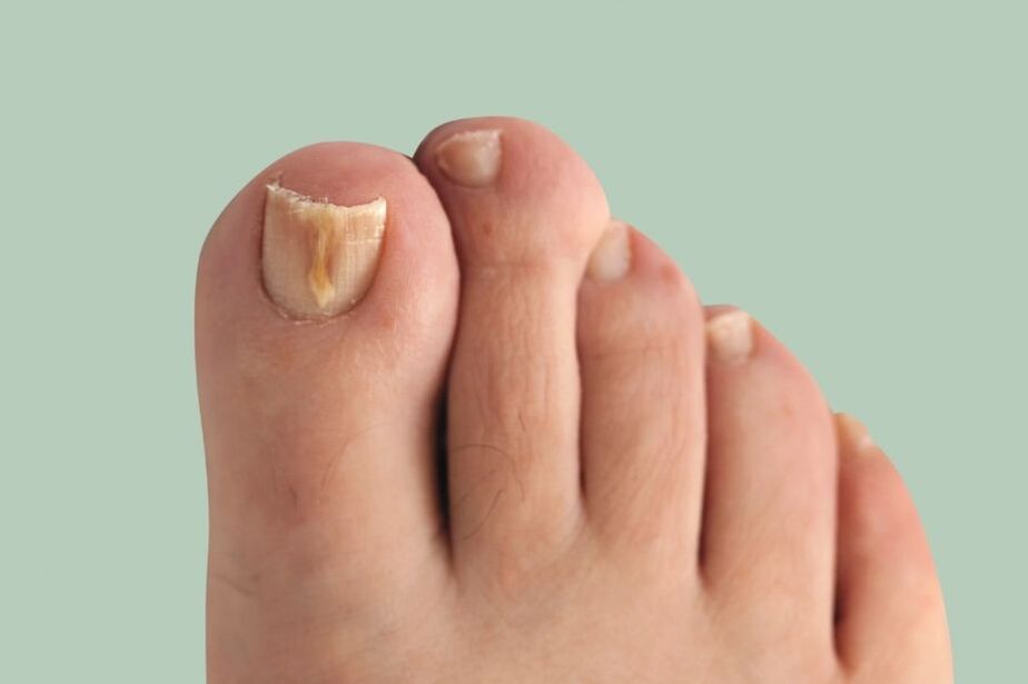 Onychomycosis symptoms