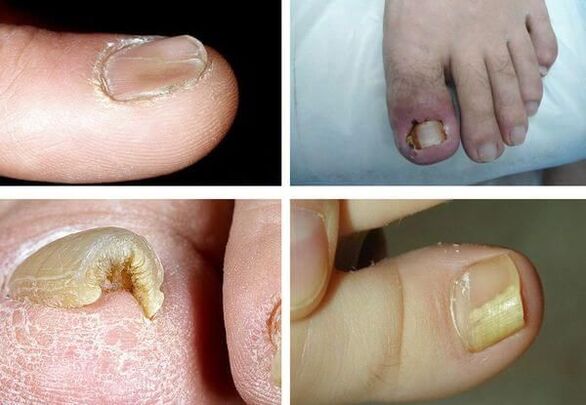 What does onychomycosis look like 