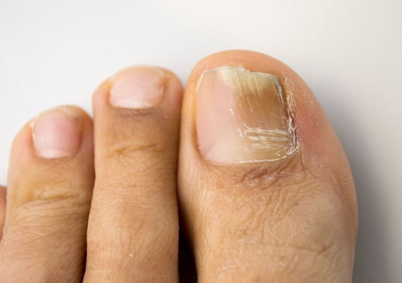 Onychomycosis on big toe