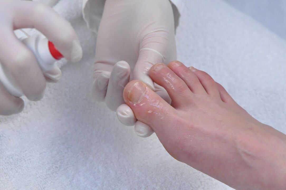 Hydrogen peroxide treats onychomycosis