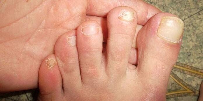 Why is onychomycosis dangerous 