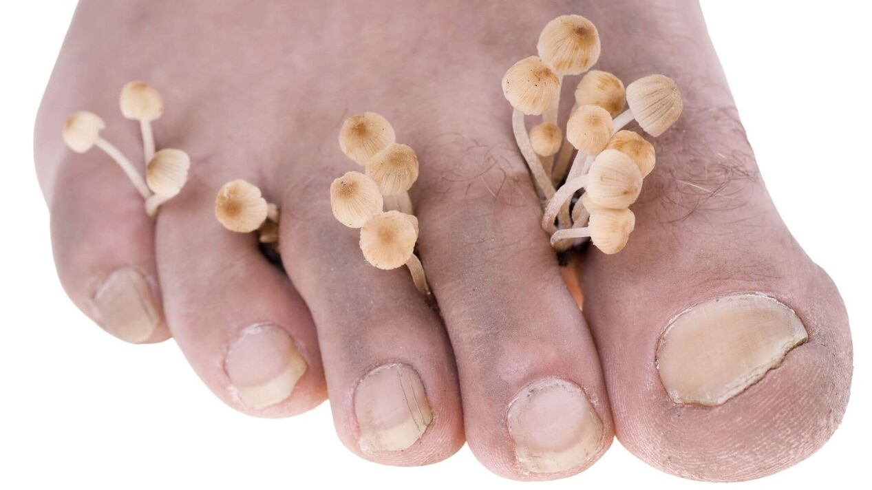 Human foot fungal infection