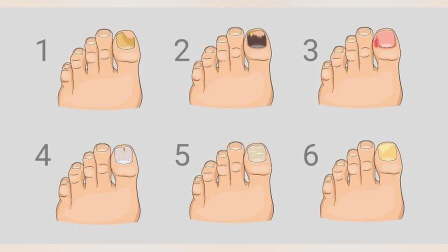 Key symptoms of foot fungus