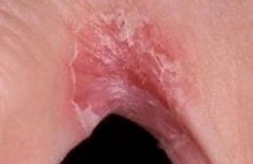 Fungus on the legs between fingers