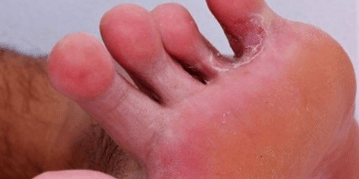 Fungus on the legs