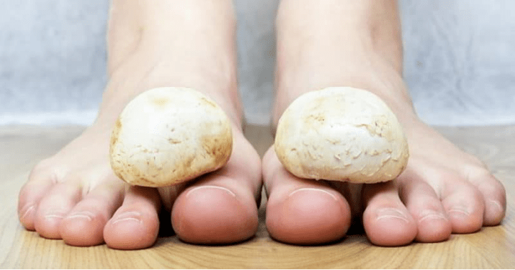 Quickly treat fungi on legs at home