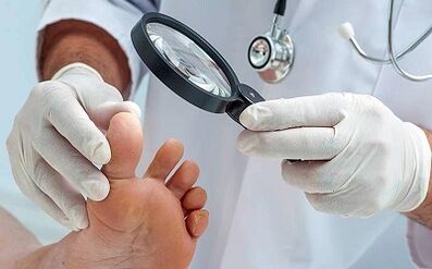 How to get rid of nail fungi