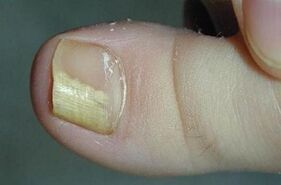 Causes of fungi appearing on the thumb of the leg