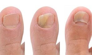 Fungal development stage of the thumb