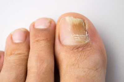 Fungal diseases caused by yeast microorganisms
