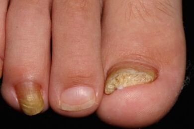 Nails on the legs
