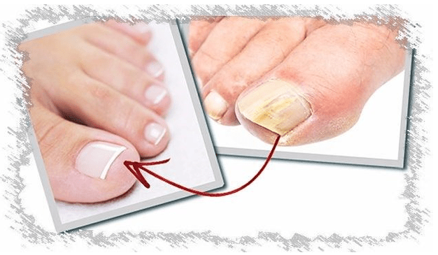 Causes of nail fungi