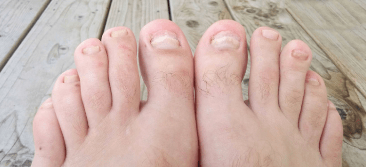 Nail fungus
