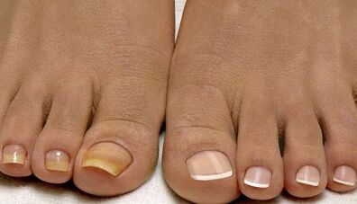 Causes of fungi appearing on nails