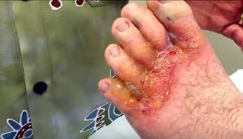 Symptoms of fungus on toes
