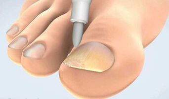 Onychomycosis scraping collection