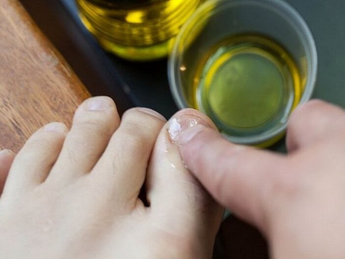 Apply medicated oil to fungal infected nails