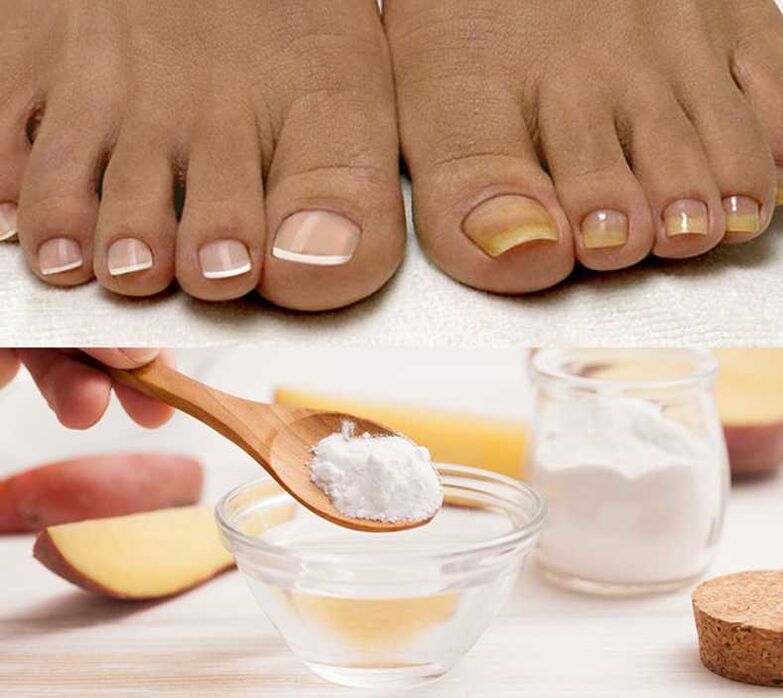 Soda Water for Nail Fungus Treatment