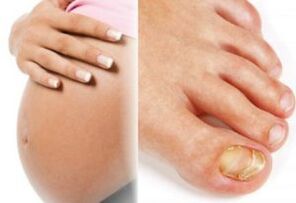 Pregnancy and onychomycosis
