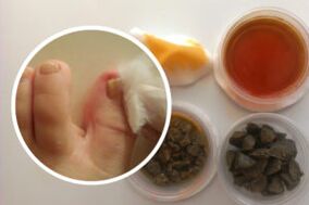 Treat toenail fungus with folk remedies