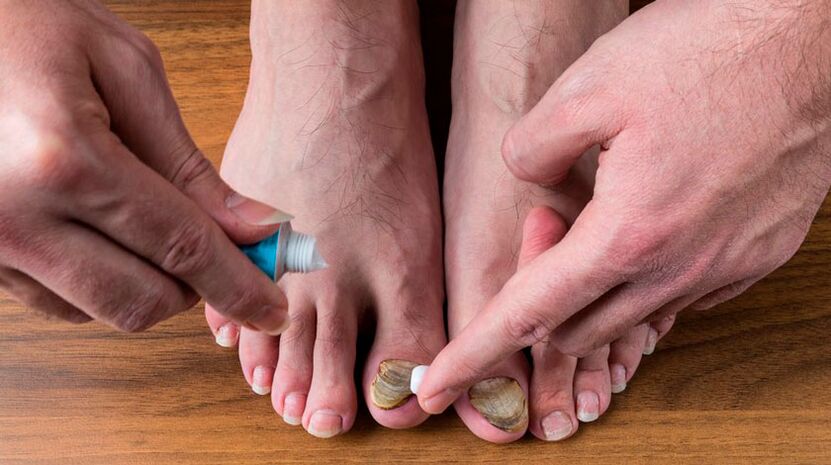 Apply antifungal cream to toenails to treat onychomycosis